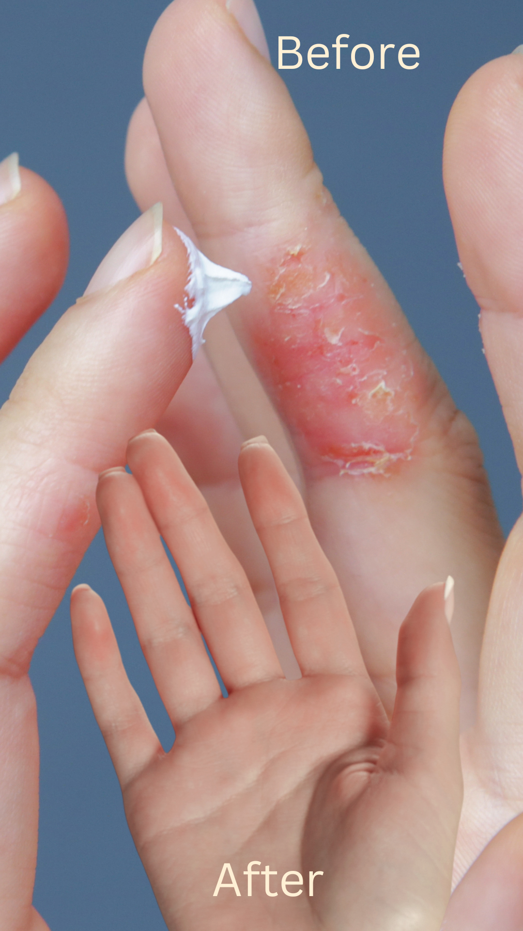 Aczema Cream - Image 2